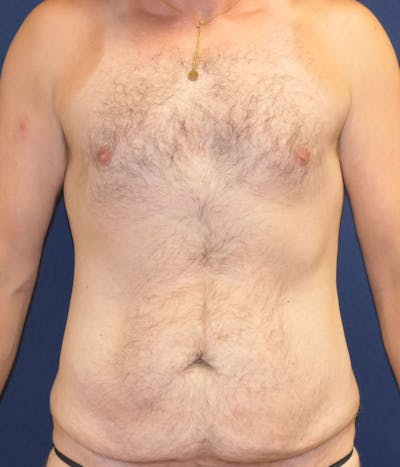 Tummy Tuck (Abdominoplasty) Before & After Gallery - Patient 594776 - Image 1