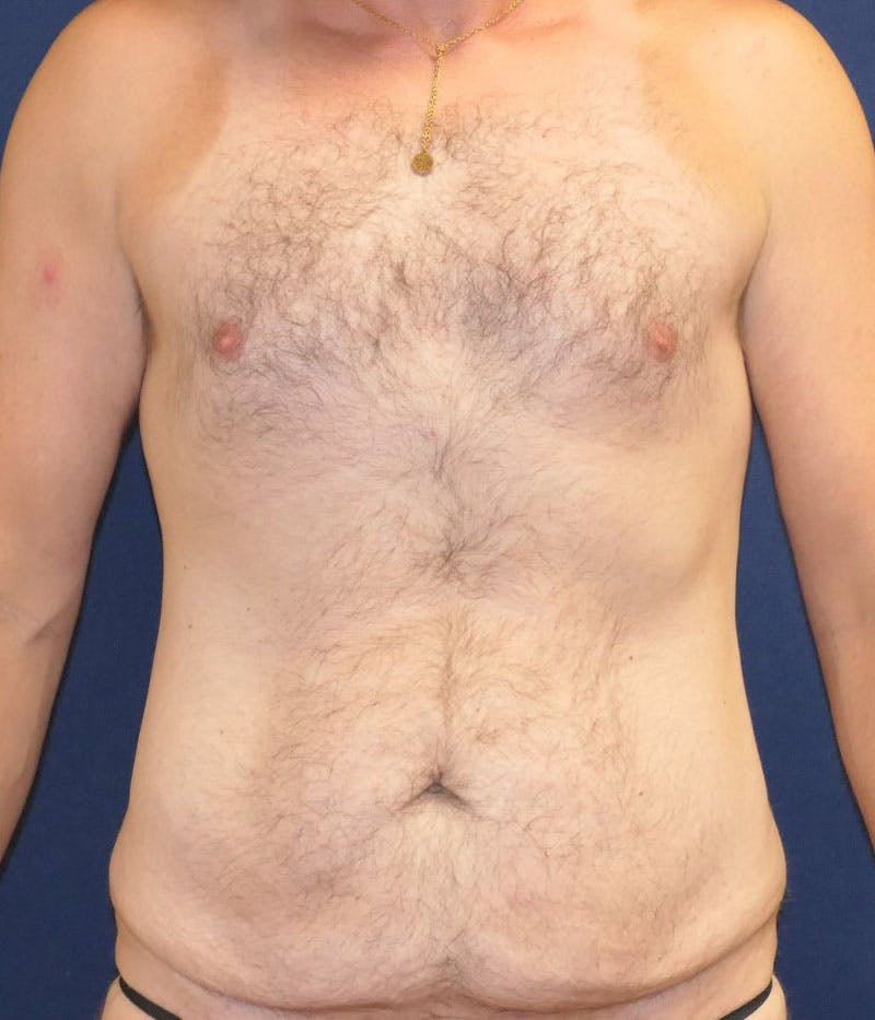 Tummy Tuck (Abdominoplasty) Before & After Gallery - Patient 594776 - Image 1