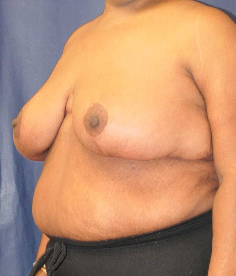 Breast Lift Before & After Gallery - Patient 387333 - Image 8