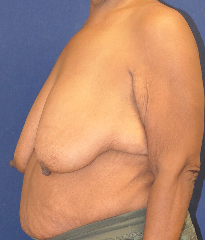 Breast Lift Before & After Gallery - Patient 387333 - Image 7