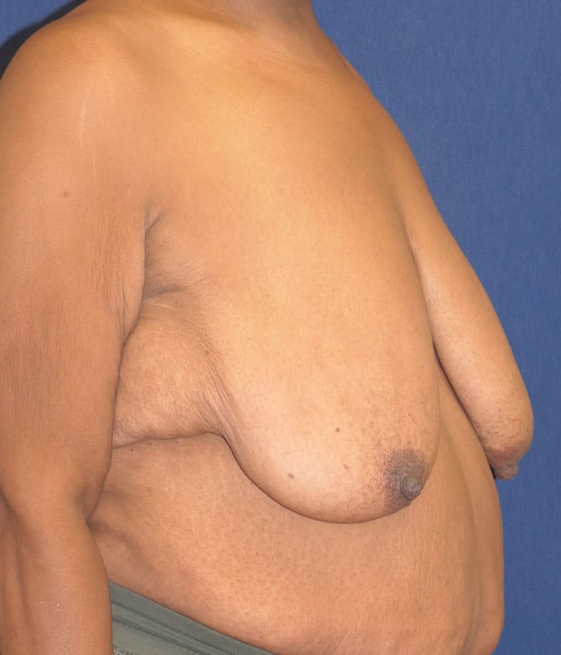 Breast Lift Before & After Gallery - Patient 387333 - Image 5