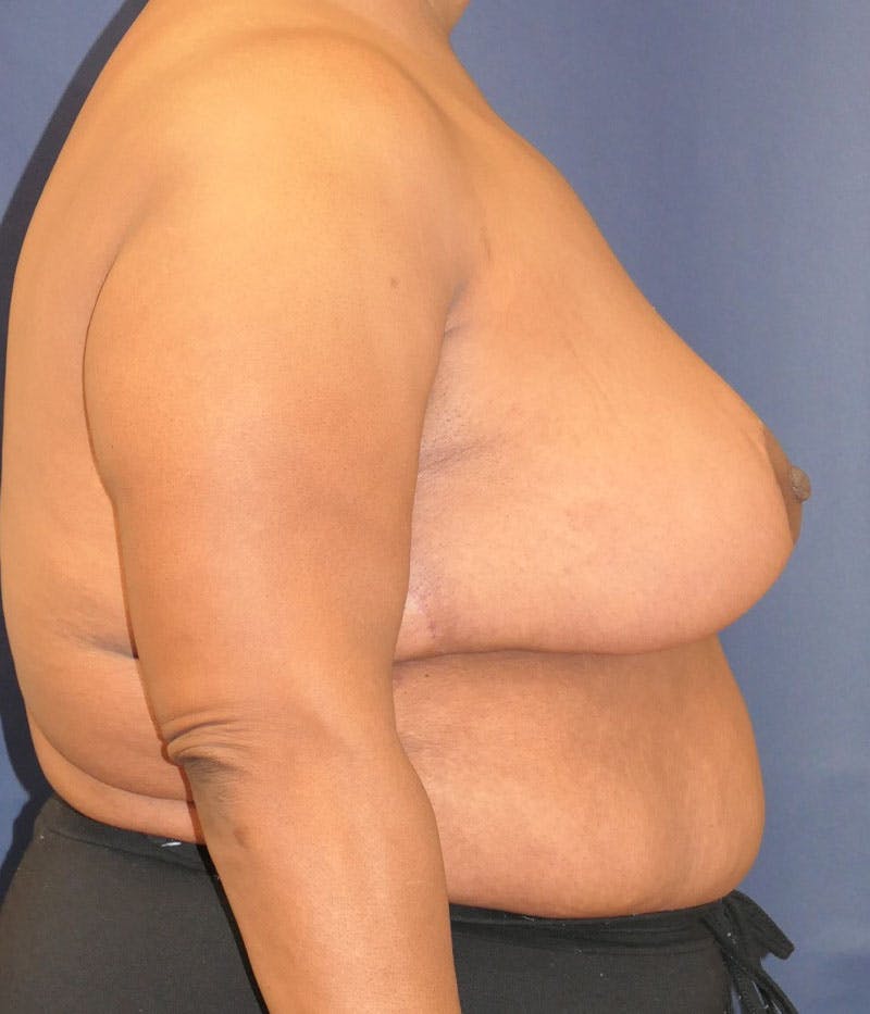 Breast Lift Before & After Gallery - Patient 387333 - Image 4