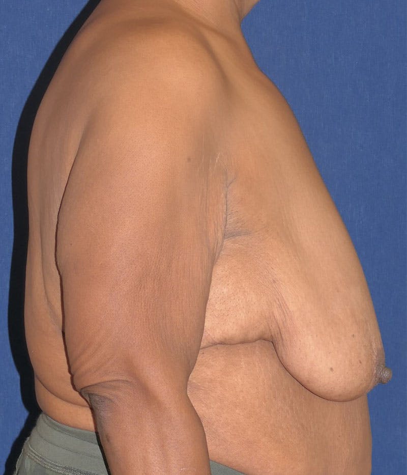 Breast Lift Before & After Gallery - Patient 387333 - Image 3