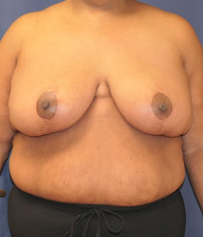Breast Lift Before & After Gallery - Patient 426715 - Image 2