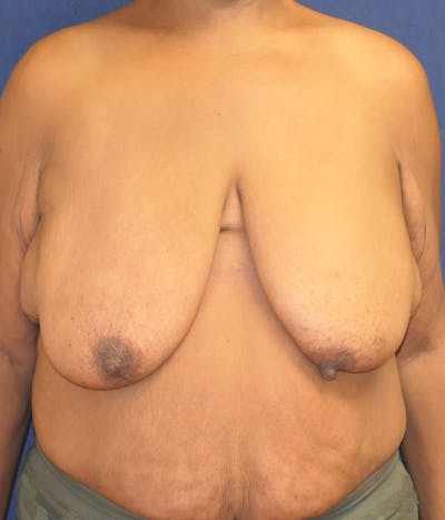 Breast Lift Before & After Gallery - Patient 426715 - Image 1