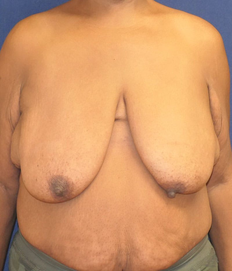 Breast Lift Before & After Gallery - Patient 387333 - Image 1
