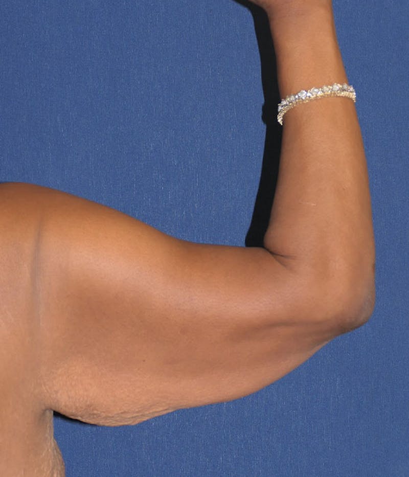 Arm Lift (Brachioplasty) Before & After Gallery - Patient 161381 - Image 7