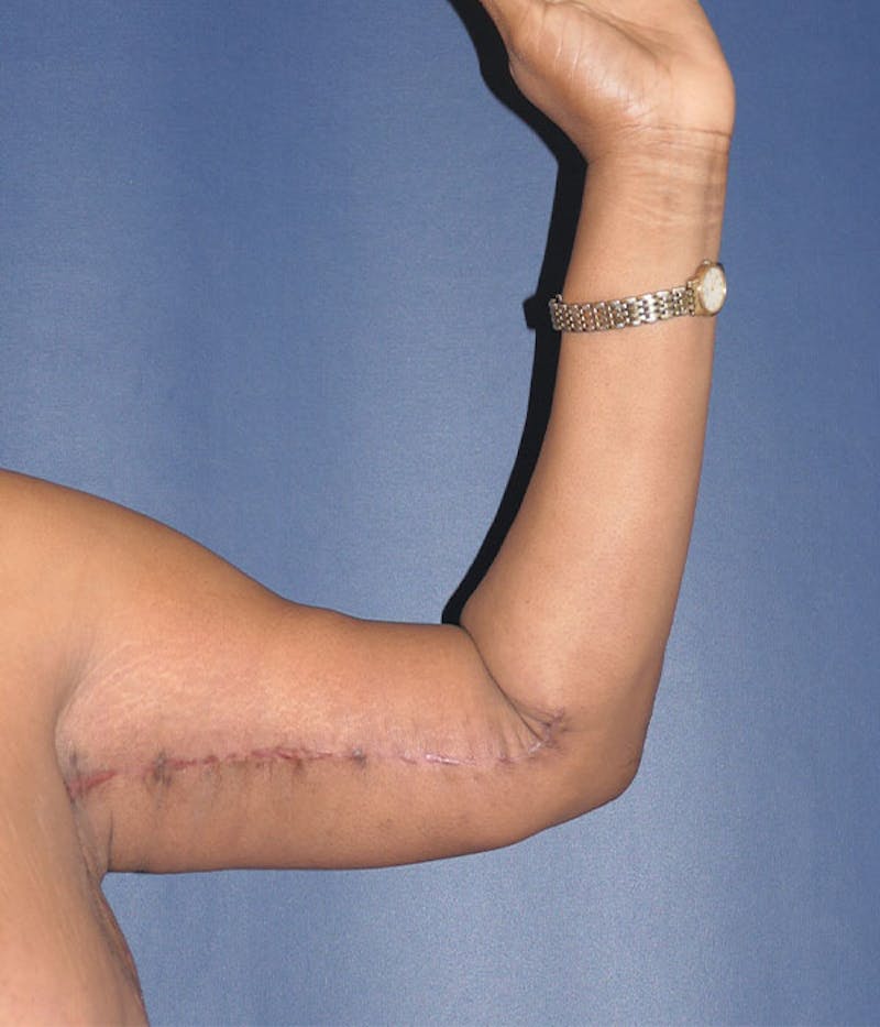 Arm Lift (Brachioplasty) Before & After Gallery - Patient 161381 - Image 6
