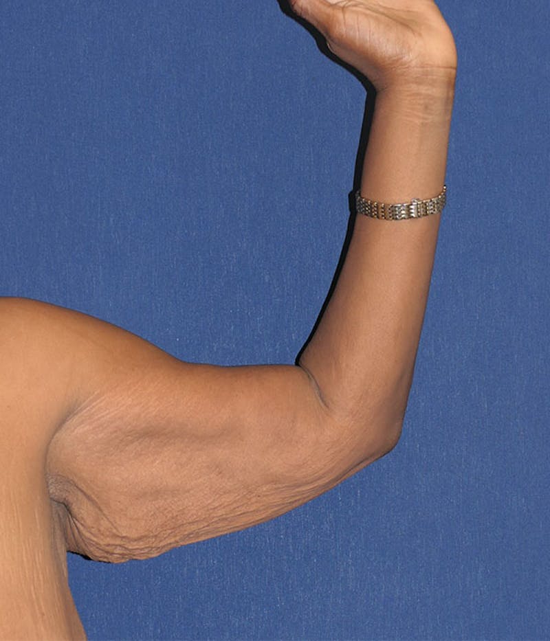 Arm Lift (Brachioplasty) Before & After Gallery - Patient 161381 - Image 5