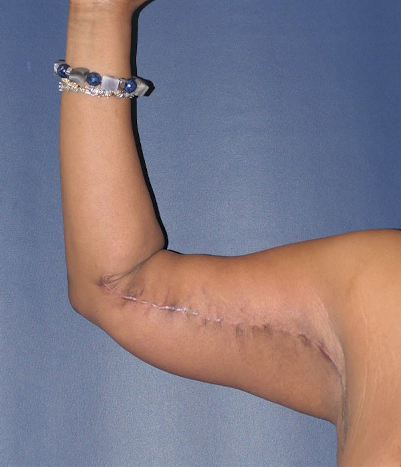 Arm Lift (Brachioplasty) Before & After Gallery - Patient 161381 - Image 4