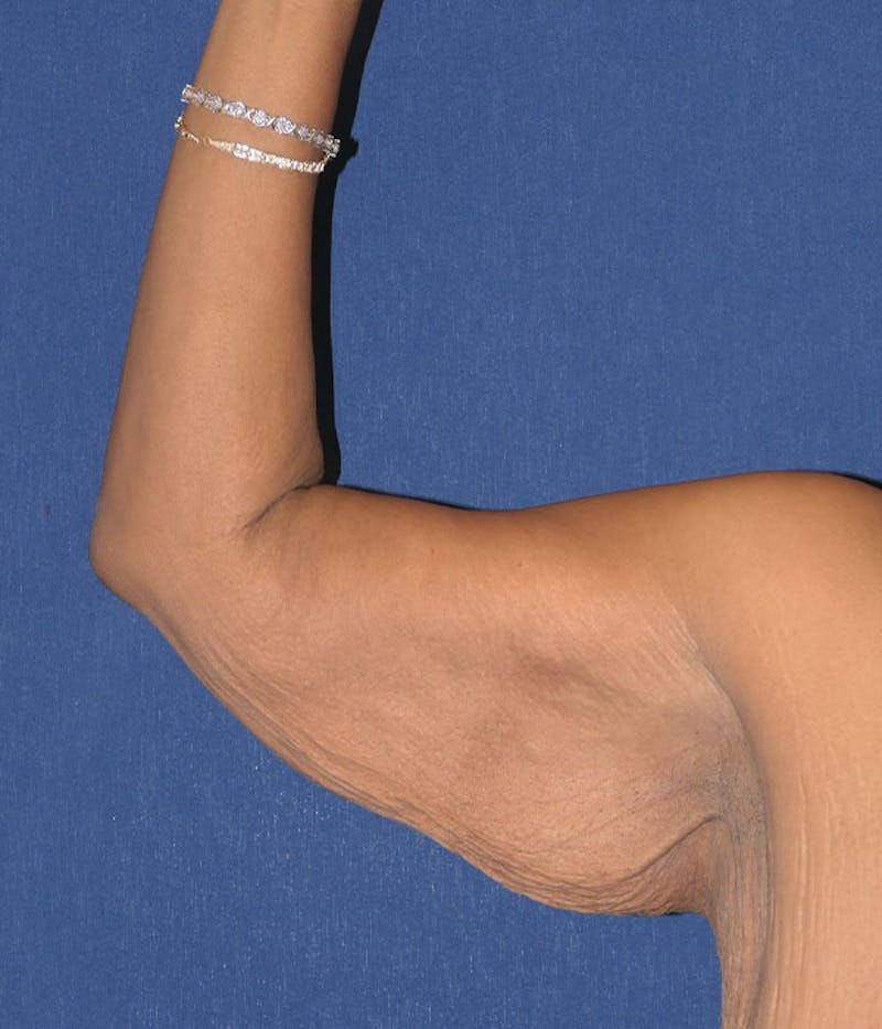 Arm Lift (Brachioplasty) Before & After Gallery - Patient 161381 - Image 3