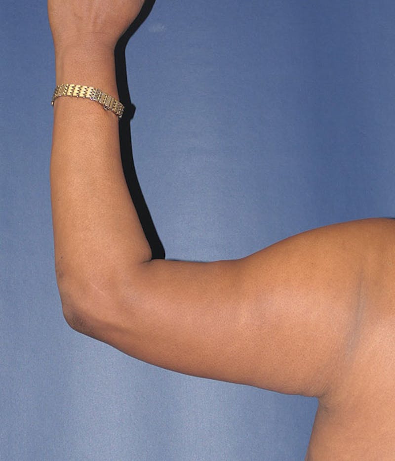 Arm Lift (Brachioplasty) Before & After Gallery - Patient 161381 - Image 2