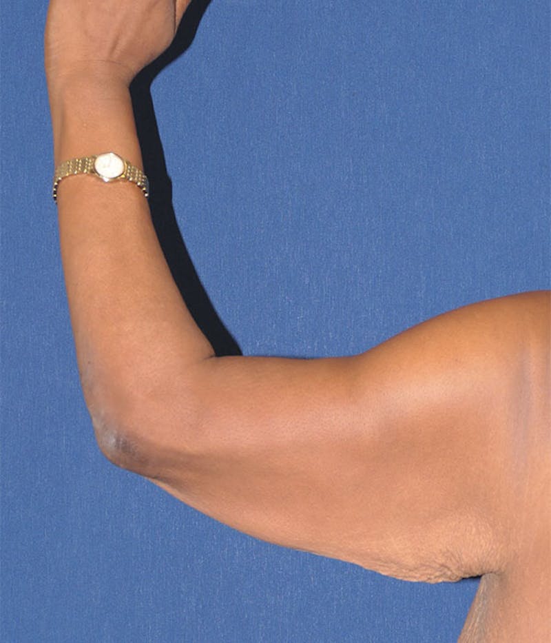 Arm Lift (Brachioplasty) Before & After Gallery - Patient 161381 - Image 1