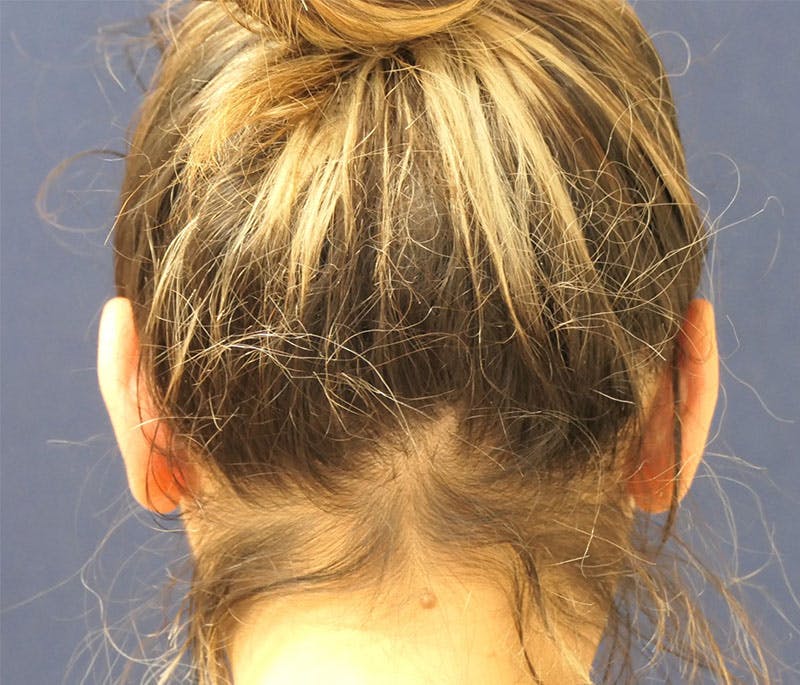 Ear Pinning (Otoplasty) Before & After Gallery - Patient 310723 - Image 6