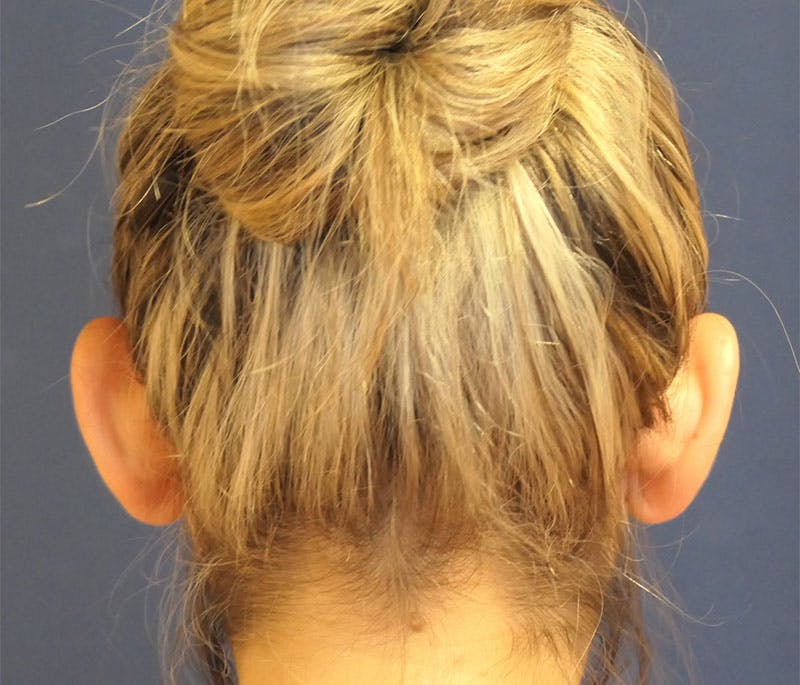 Ear Pinning (Otoplasty) Before & After Gallery - Patient 310723 - Image 5