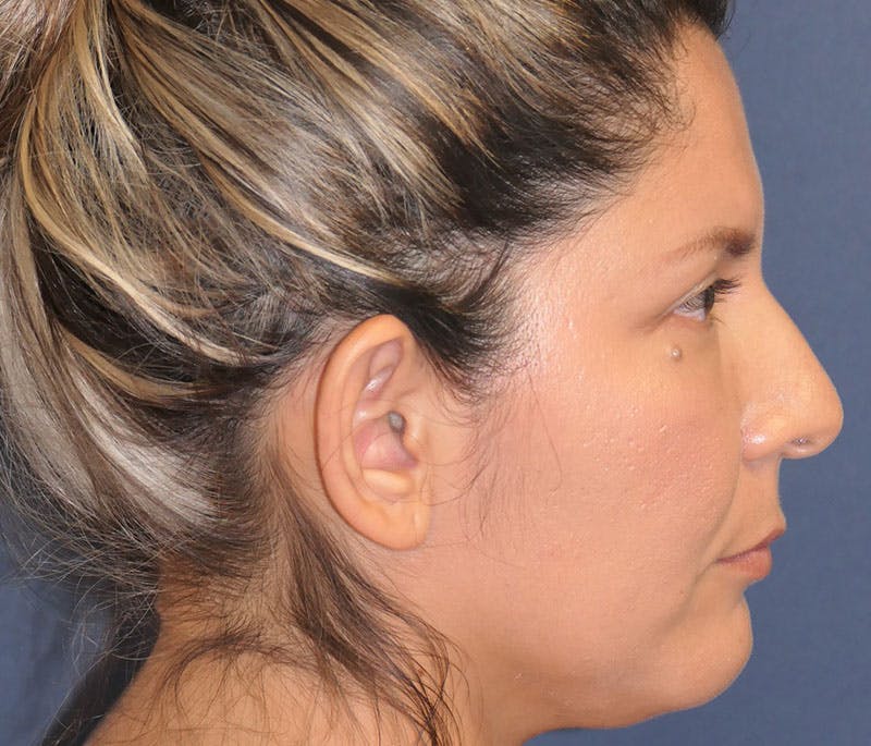 Ear Pinning (Otoplasty) Before & After Gallery - Patient 310723 - Image 3