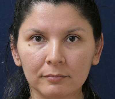 Ear Pinning (Otoplasty) Before & After Gallery - Patient 310723 - Image 2