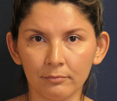 Ear Pinning (Otoplasty) Before & After Gallery - Patient 310723 - Image 1