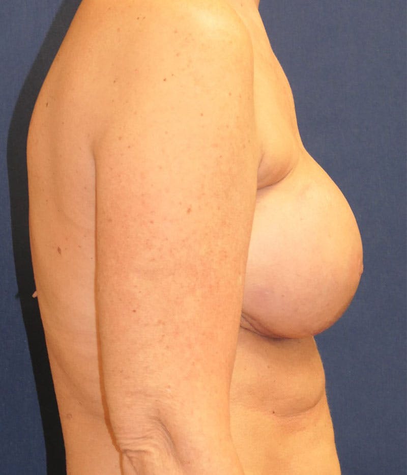 Breast Reconstruction with Implants Only Before & After Gallery - Patient 276864 - Image 8