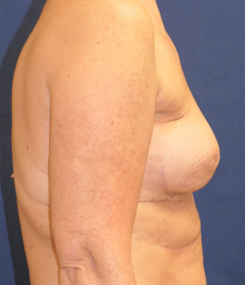 Breast Reconstruction with Implants Only Before & After Gallery - Patient 276864 - Image 7