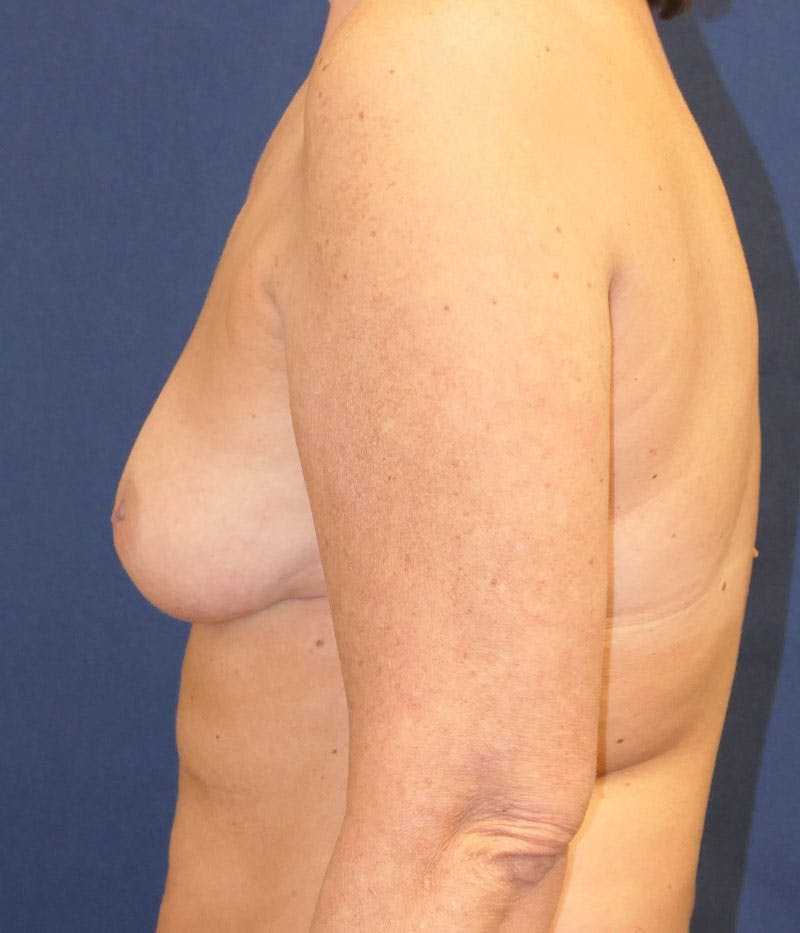 Breast Reconstruction with Implants Only Before & After Gallery - Patient 276864 - Image 5