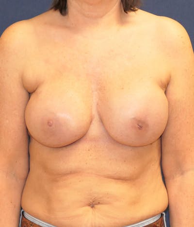 Breast Reconstruction with Implants Only Before & After Gallery - Patient 276864 - Image 2
