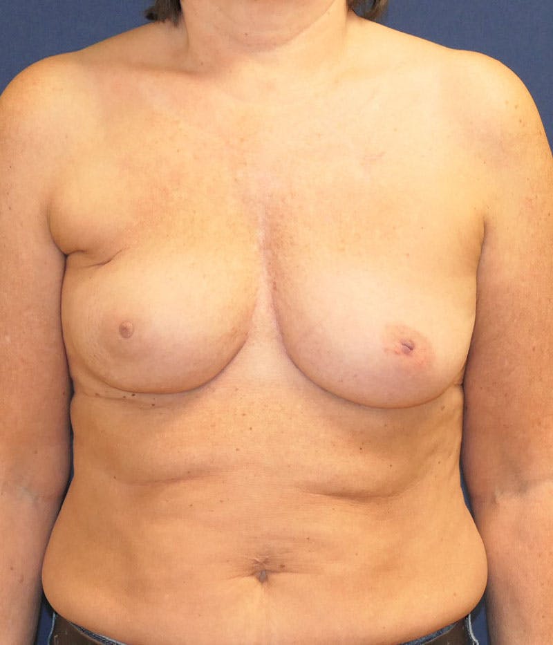 Breast Reconstruction with Implants Only Before & After Gallery - Patient 276864 - Image 1
