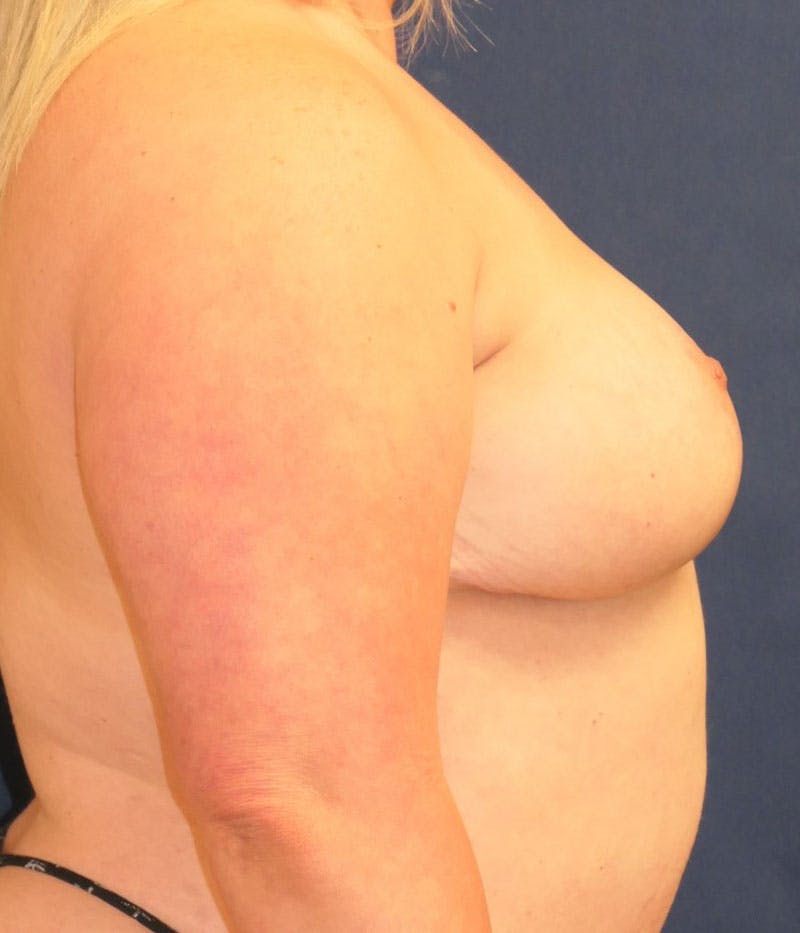 Breast Reconstruction with Implants Only Before & After Gallery - Patient 767185 - Image 7