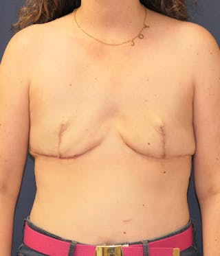 Breast Reconstruction with Autologous Tissue Before & After Gallery - Patient 375685 - Image 2