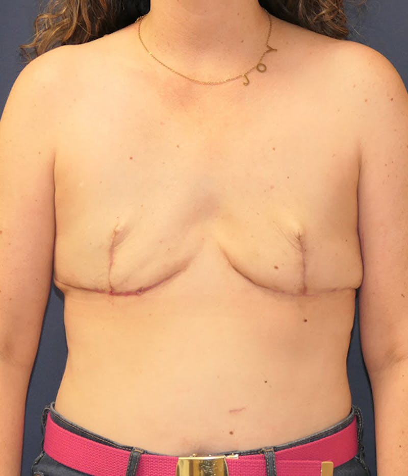 Breast Reconstruction with Autologous Tissue Before & After Gallery - Patient 375685 - Image 2