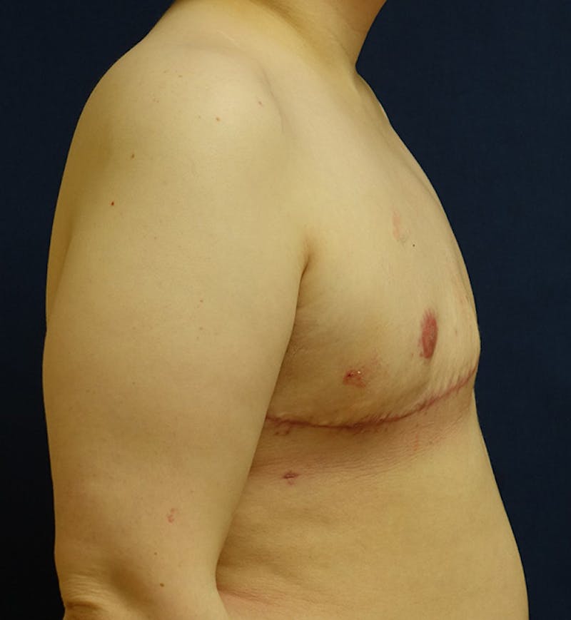 Masculinizing Surgery Before & After Gallery - Patient 180694 - Image 4