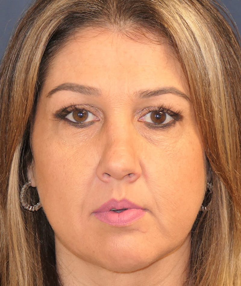 Scars/Malformations Before & After Gallery - Patient 377041 - Image 2