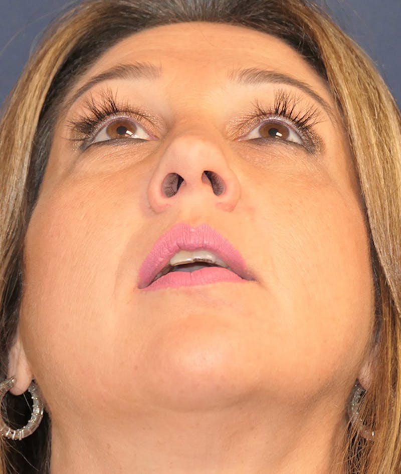 Scars/Malformations Before & After Gallery - Patient 377041 - Image 4