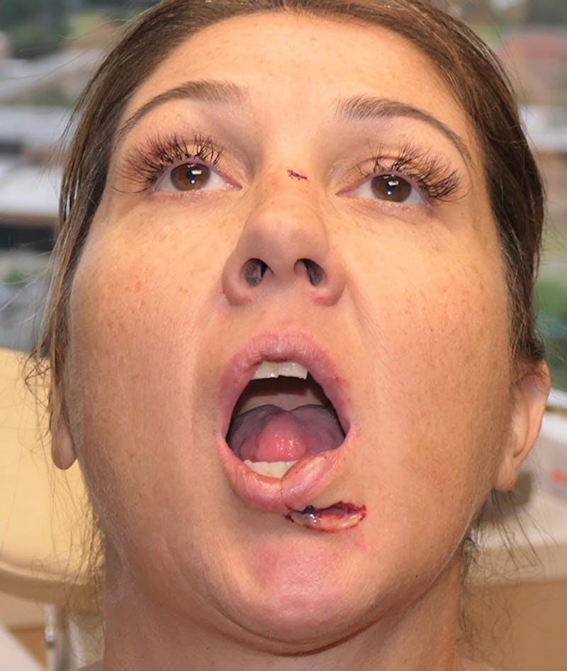 Scars/Malformations Before & After Gallery - Patient 377041 - Image 3