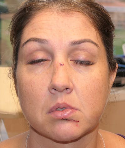 Scars/Malformations Before & After Gallery - Patient 377041 - Image 1