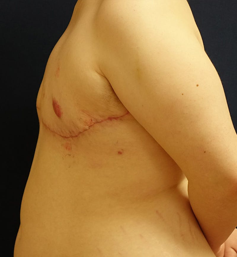 Masculinizing Surgery Before & After Gallery - Patient 180694 - Image 6