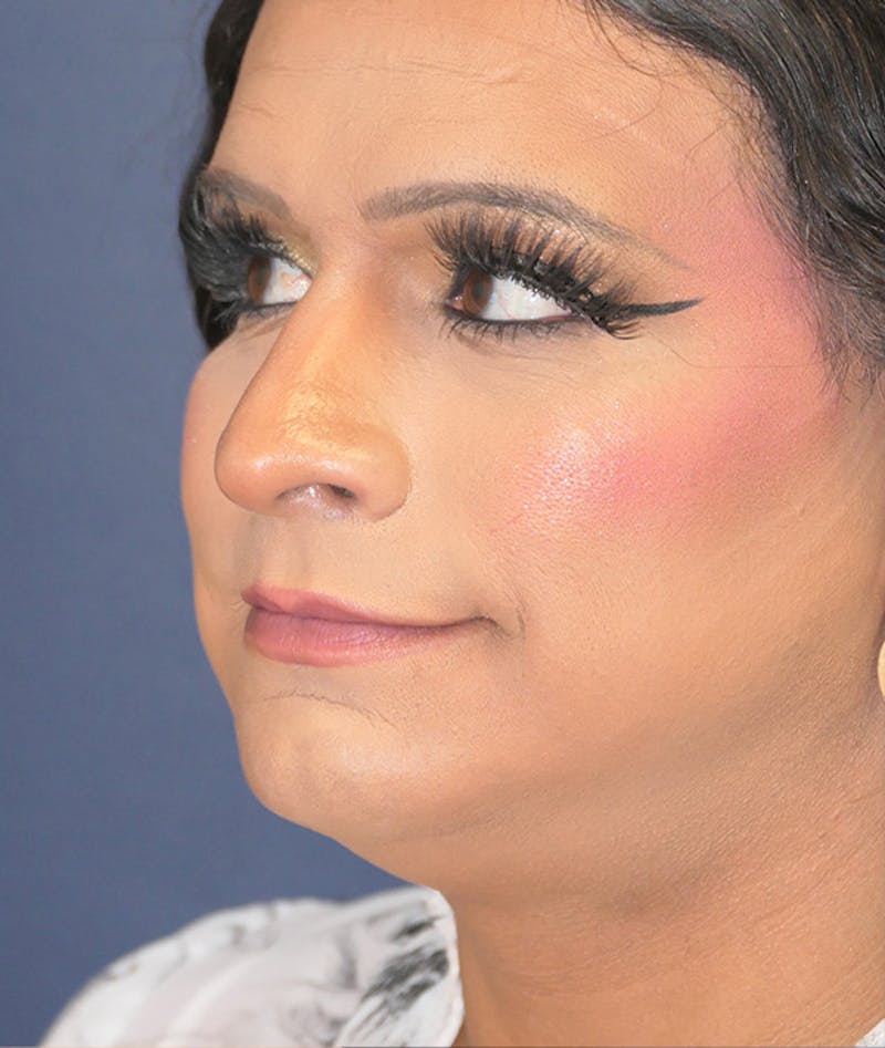 Feminizing Surgery Before & After Gallery - Patient 128939 - Image 9