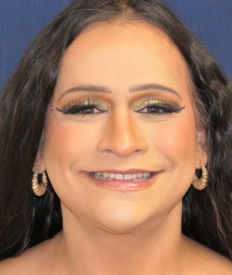 Feminizing Surgery Before & After Gallery - Patient 128939 - Image 4