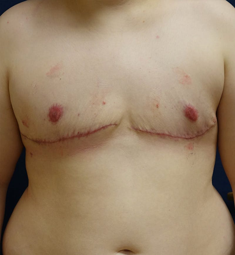 Masculinizing Surgery Before & After Gallery - Patient 180694 - Image 2