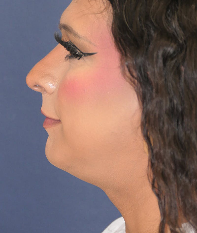 Feminizing Surgery Before & After Gallery - Patient 128939 - Image 11