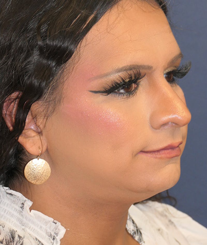 Feminizing Surgery Before & After Gallery - Patient 128939 - Image 5