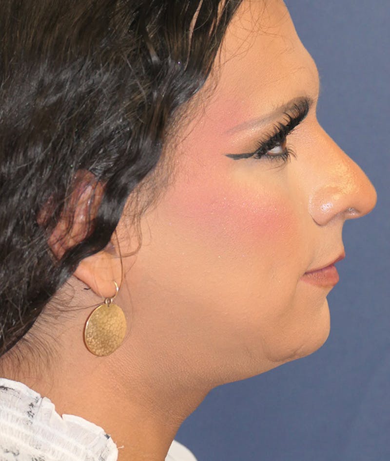 Feminizing Surgery Before & After Gallery - Patient 128939 - Image 7