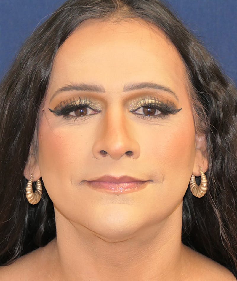Feminizing Surgery Before & After Gallery - Patient 128939 - Image 2
