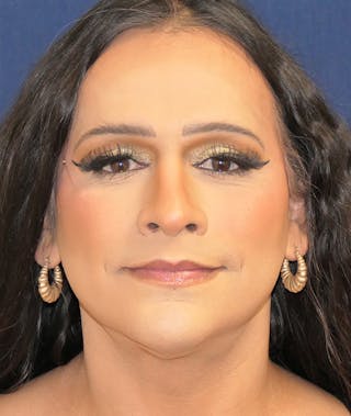 Feminizing Surgery Before & After Gallery - Patient 128939 - Image 2