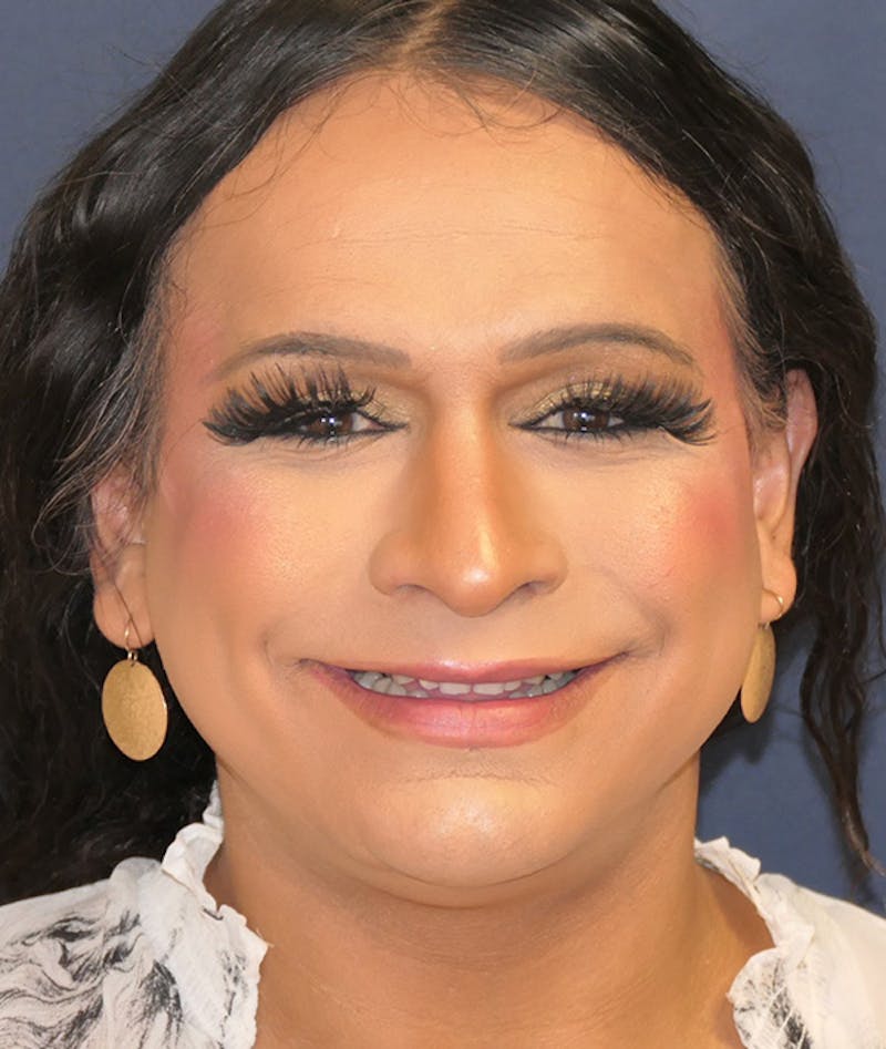 Feminizing Surgery Before & After Gallery - Patient 128939 - Image 3