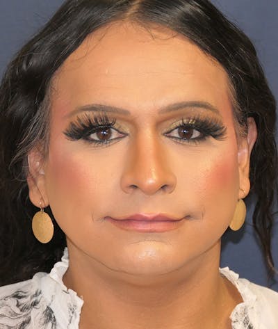 Feminizing Surgery Before & After Gallery - Patient 128939 - Image 1