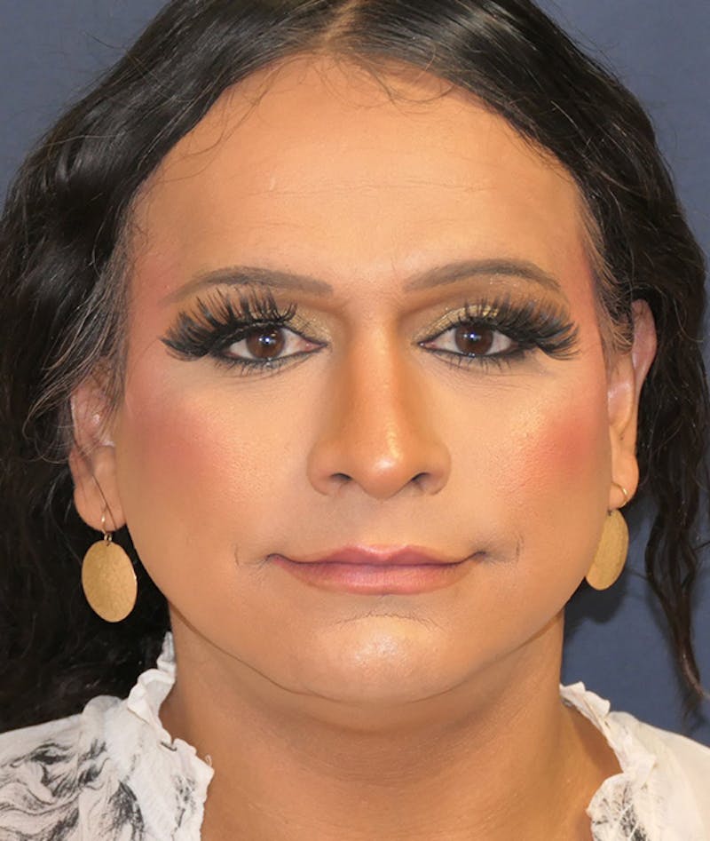 Feminizing Surgery Before & After Gallery - Patient 128939 - Image 1