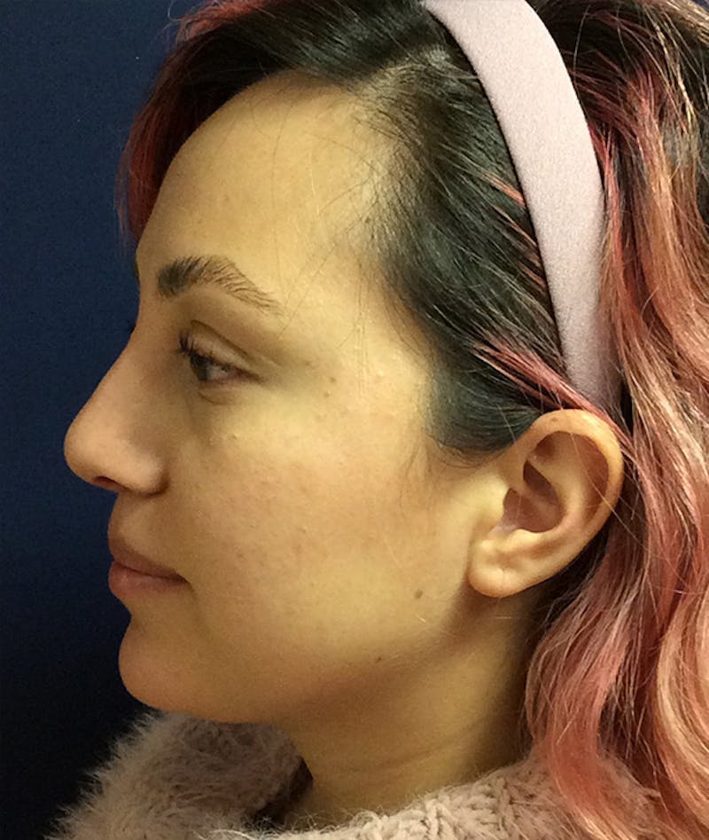 Rhinoplasty Before & After Gallery - Patient 397447 - Image 4