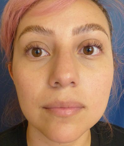 Rhinoplasty Before & After Gallery - Patient 397447 - Image 1