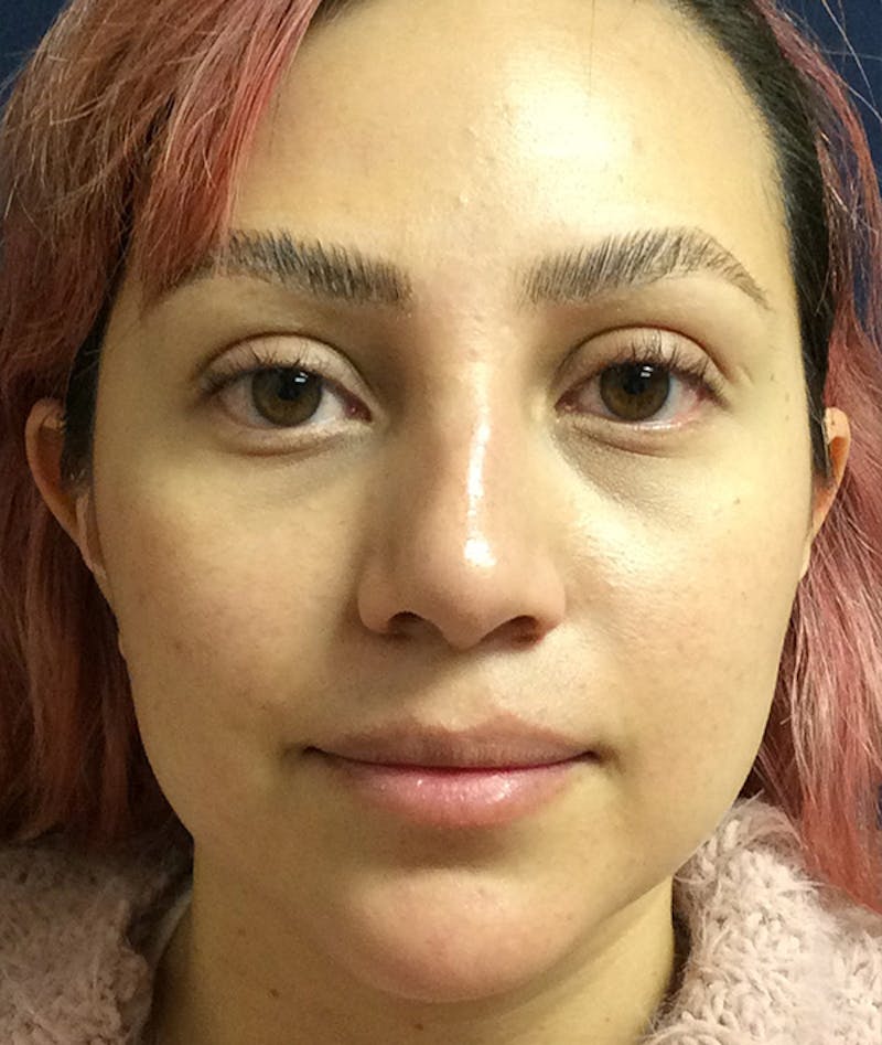 Rhinoplasty Before & After Gallery - Patient 397447 - Image 2